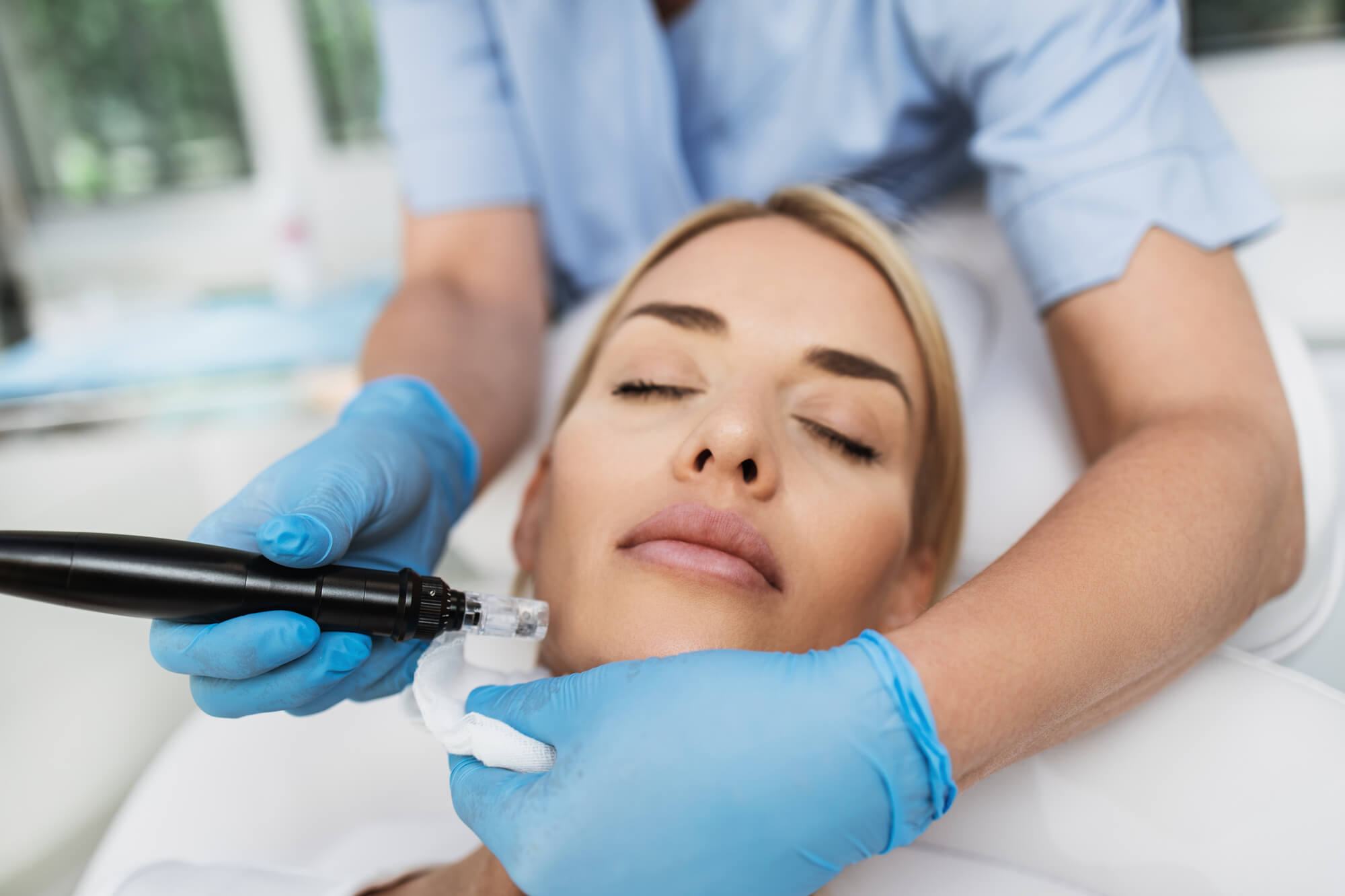 Microneedling Treatment